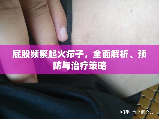 屁股频繁起火疖子，全面解析、预防与治疗策略